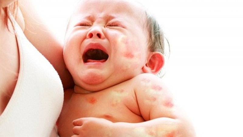 Know your baby is allergic to formula milk, cow's milk